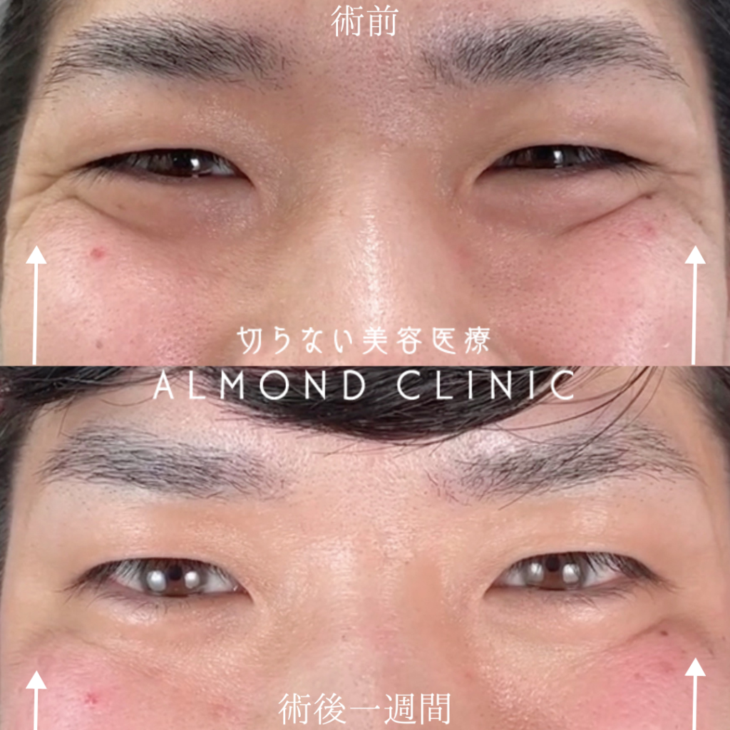 ヴィジョン・ド・ボーテ12個セット塗るボトックスおでこや目尻のシワに スキンケア・基礎, image size:1024x1024