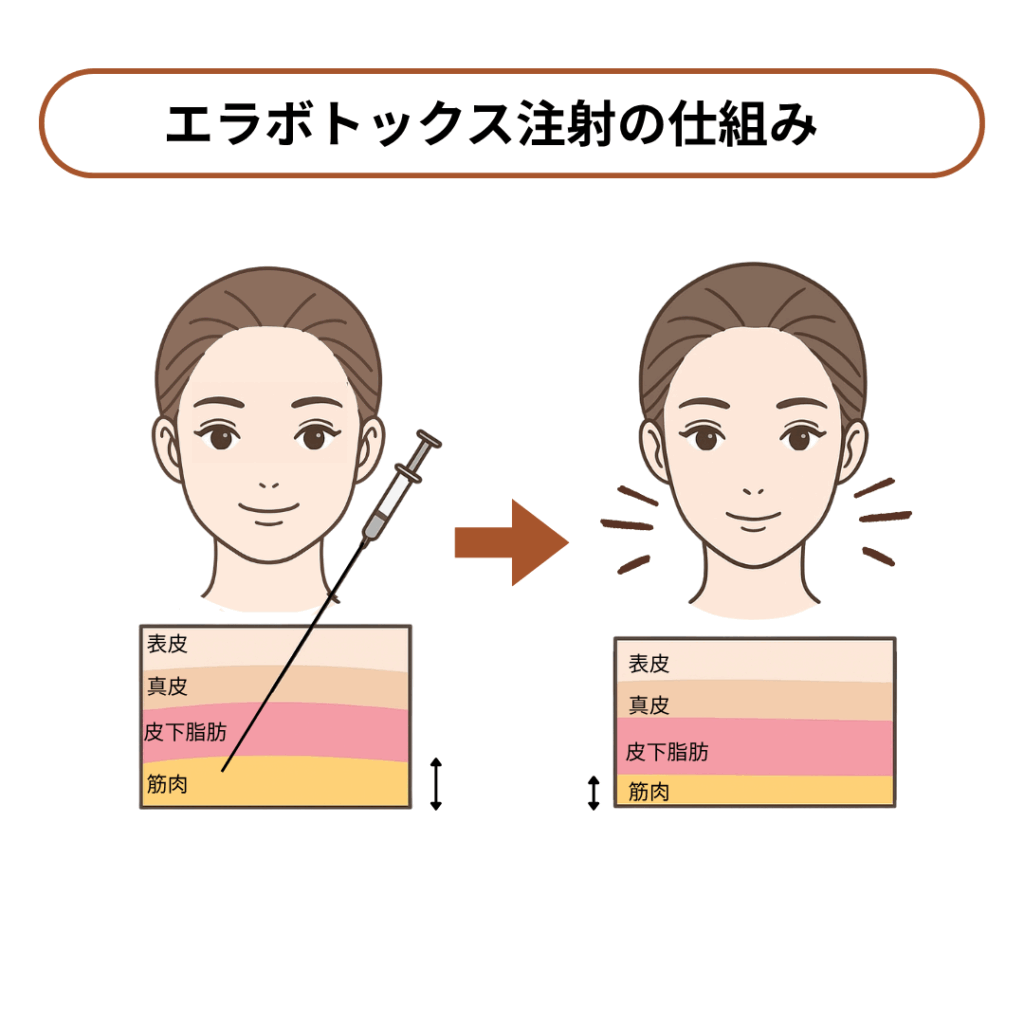 エラボトックスの「単位」を医師がわかりやすく解説！40単位・80単位で効果は異なる？ - 【公式】 アーモンドクリニック｜美容外科・美容皮膚科