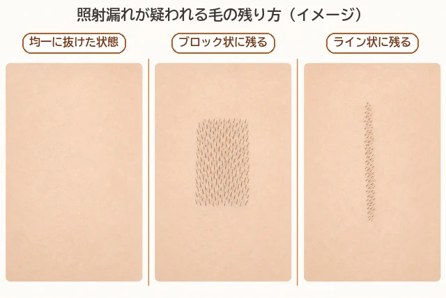リゼクリニックの照射漏れで毛がブロック状・ライン状に残るイメージ図