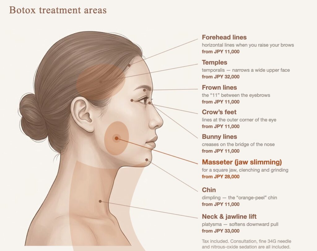 Diagram of Botox treatment areas — forehead, frown lines, crow’s feet, bunny lines, temples, masseter, chin and neck