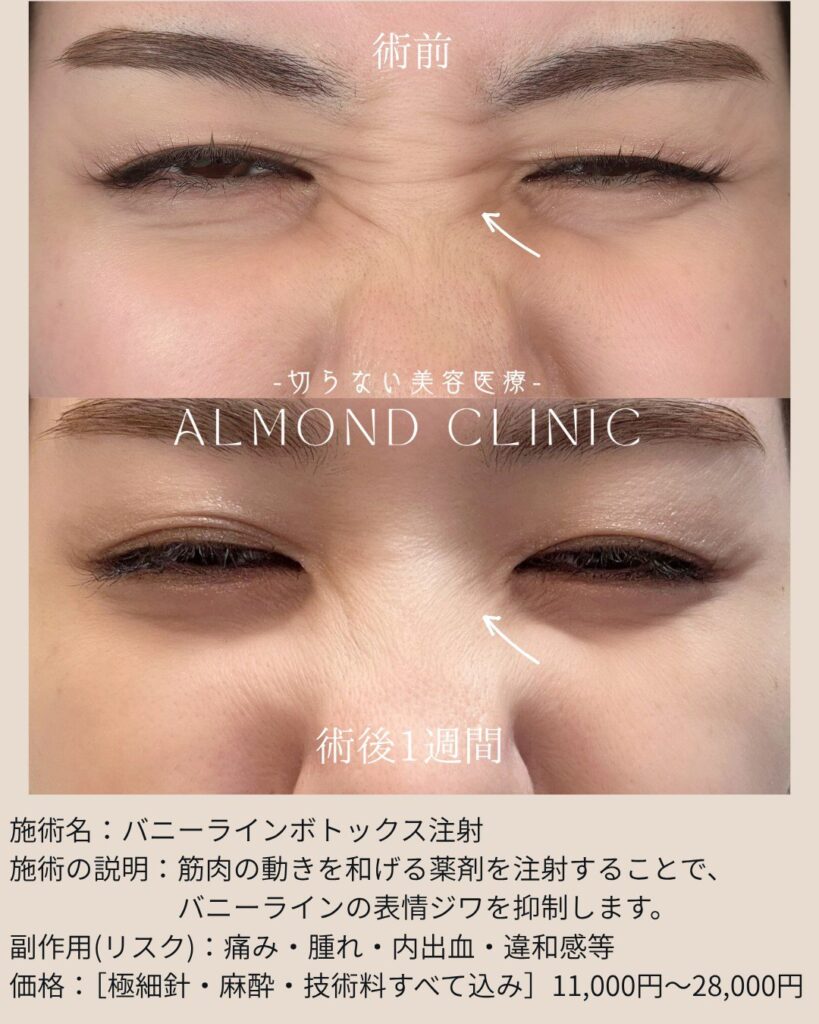 バニーライン（鼻根）ボトックス注射の症例写真（術前・術後1週間）