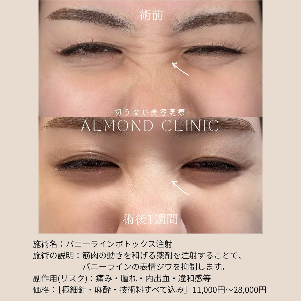 バニーライン（鼻根）ボトックス注射の症例写真（術前・術後1週間）