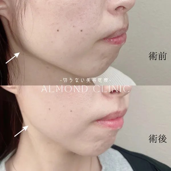 エラボトックス注射の症例写真（術前・術後／約40単位）