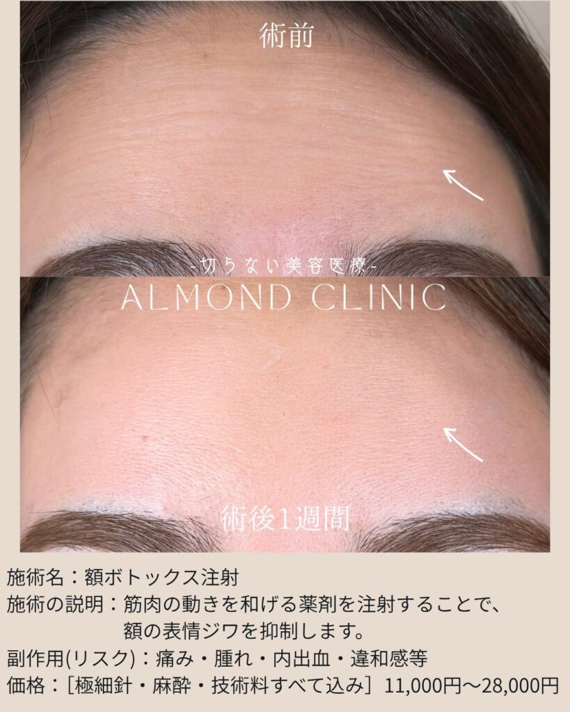額ボトックス注射の症例写真（術前・術後1週間）