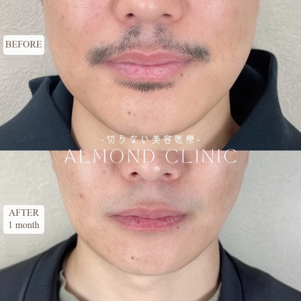Masseter Botox before and after — 80 units, one month later