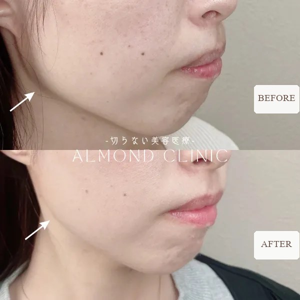 Masseter Botox before and after — jawline seen from the side