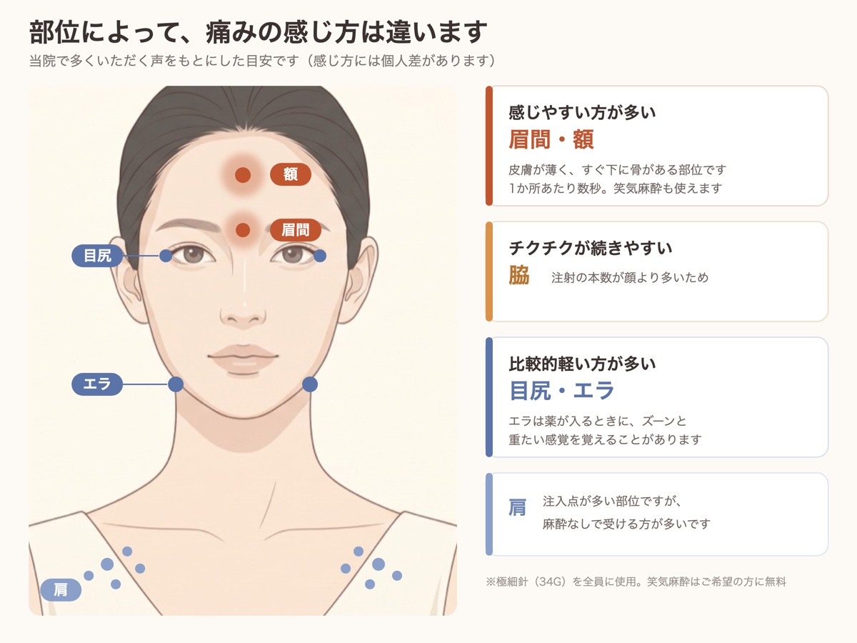ボトックスの痛みの部位別の目安。眉間・額は感じやすく、脇はチクチクが続きやすく、目尻・エラは比較的軽い。肩は注入点が多いが麻酔なしで受ける方が多い