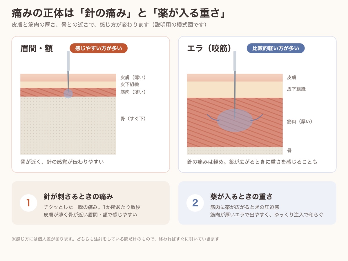 ボトックスの痛みの正体を示す模式図。眉間・額は皮膚が薄く骨が近いため針の痛みを感じやすく、エラは筋肉が厚く薬が入るときに重さを感じることがある
