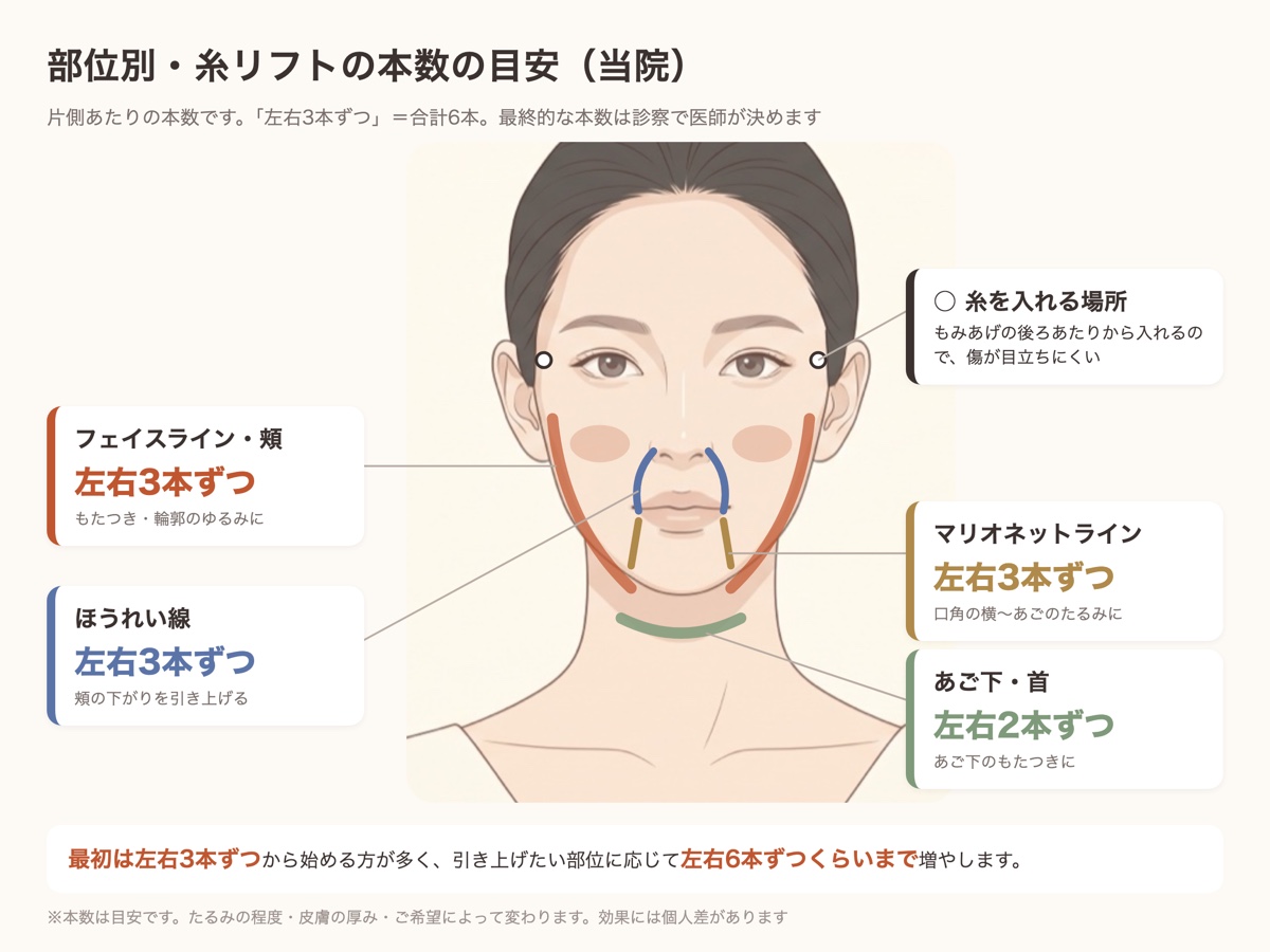 部位別の糸リフトの本数の目安（フェイスライン・頰、ほうれい線、マリオネットラインは左右3本ずつ、あご下・首は左右2本ずつ）
