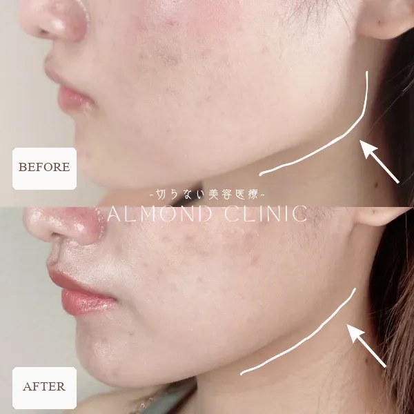 Masseter Botox before and after — approx. 40 units, one month later