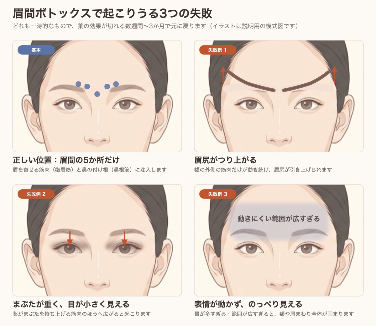 眉間ボトックスで起こりうる3つの失敗（眉尻がつり上がる・まぶたが重くなる・表情が動かない）と正しい注入位置の模式図