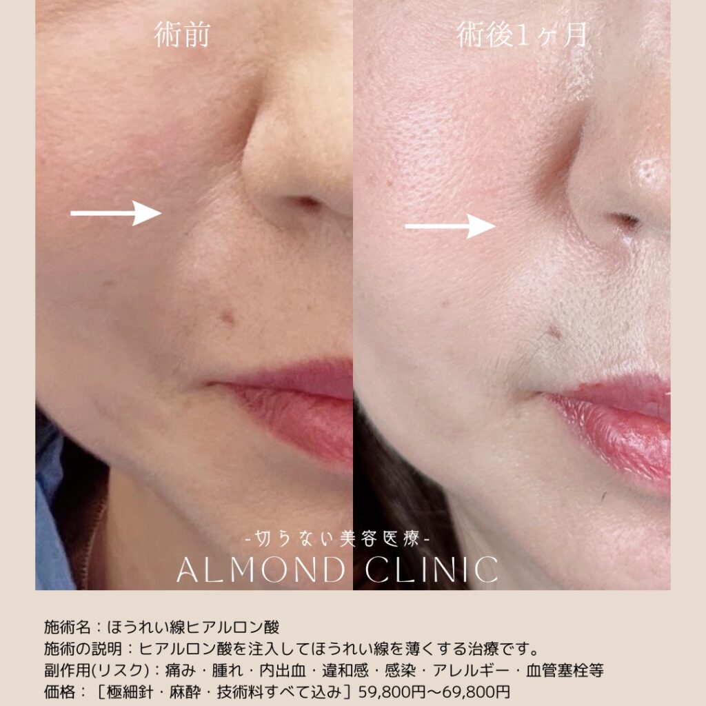 ほうれい線ヒアルロン酸注入の症例写真。術前と術後1ヶ月を左右に並べた比較