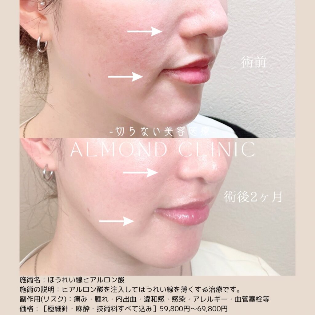 ほうれい線ヒアルロン酸注入の症例写真。術前と術後2ヶ月の斜めからの比較