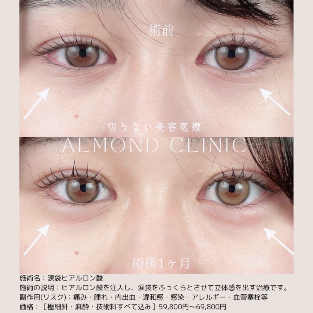 涙袋ヒアルロン酸注入の症例写真。術前と術後1ヶ月の目元の比較