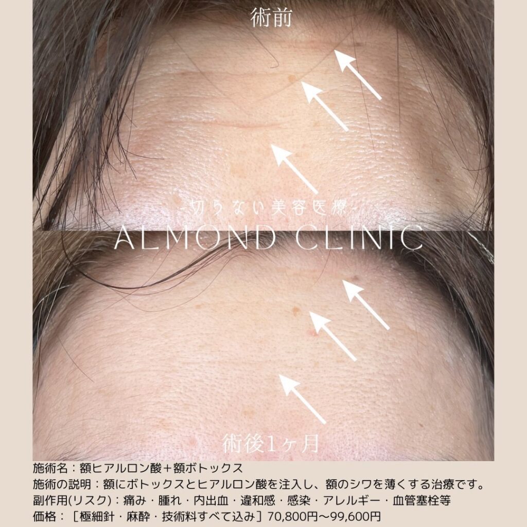 額ヒアルロン酸と額ボトックスを併用した症例写真。額のシワの術前と術後1ヶ月の比較