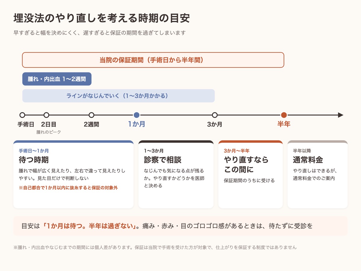 埋没法のやり直しを考える時期の目安。手術から1か月は待ち、1〜3か月でなじみ、半年までが当院の保証期間であることを示すタイムライン