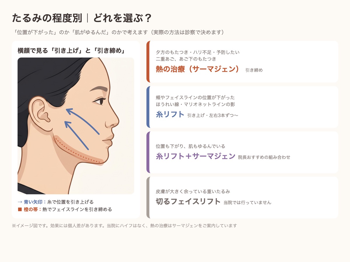 たるみの程度別の選び方。軽いもたつきはサーマジェン、位置の下がりは糸リフト、両方あれば組み合わせ、重いたるみは切るフェイスリフト