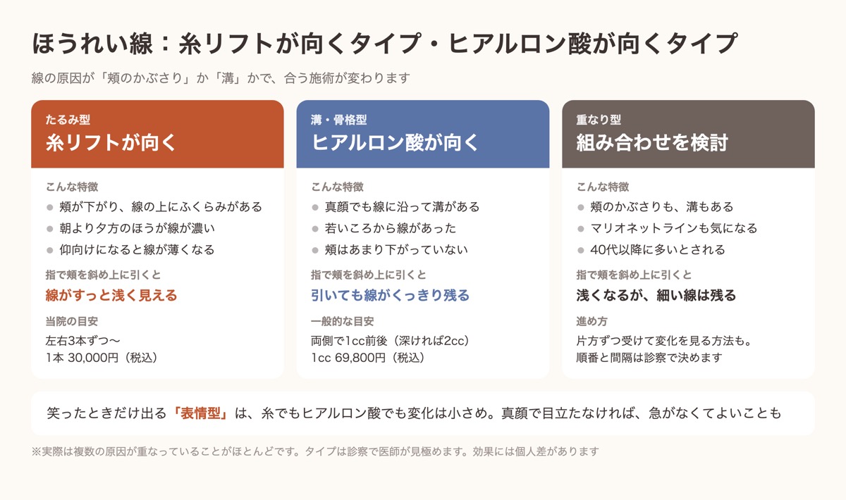 ほうれい線のタイプ別比較。たるみ型は糸リフト、溝・骨格型はヒアルロン酸、重なり型は組み合わせを検討