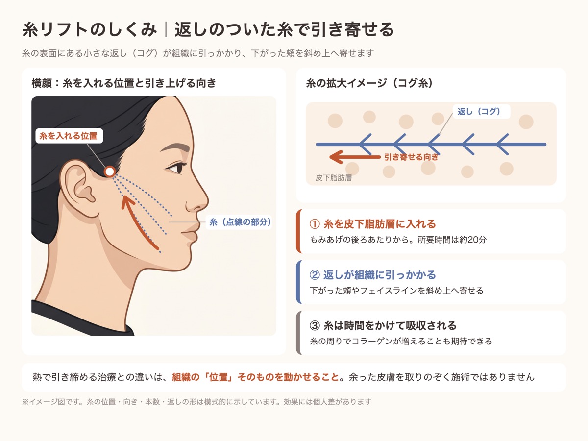 糸リフトのしくみ。もみあげの後ろあたりから入れた返し（コグ）つきの糸が、皮下脂肪層の組織を斜め上へ引き寄せるイメージ図