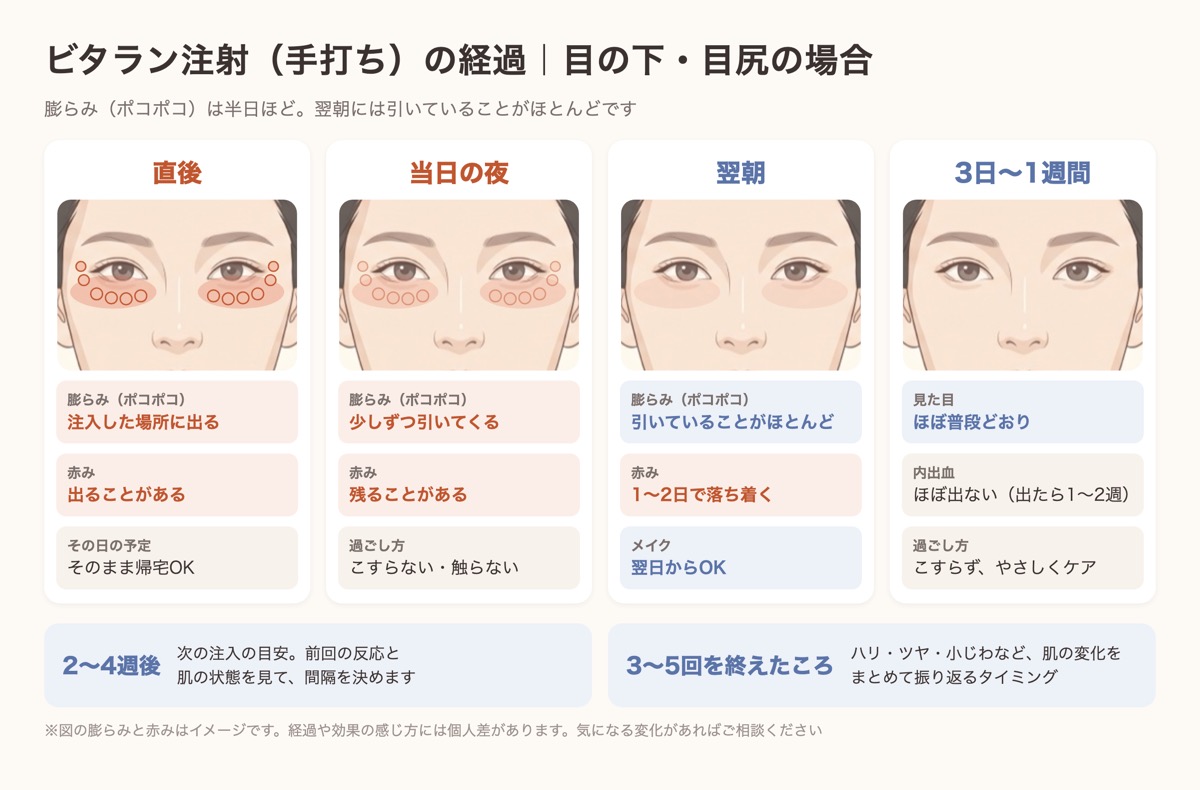 ビタラン注射を目の下と目尻に手打ちしたあとの経過。直後と当日夜は注入した場所が小さく膨らみ、翌朝には引いていることがほとんど、3日〜1週間でほぼ普段どおり
