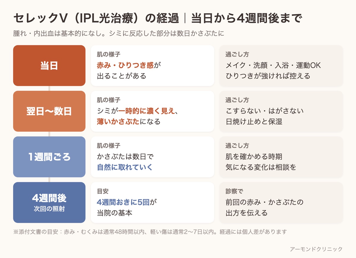 セレックV(IPL光治療)の経過を当日・翌日〜数日・1週間ごろ・4週間後の4段階で、肌の様子と過ごし方に分けて示した図