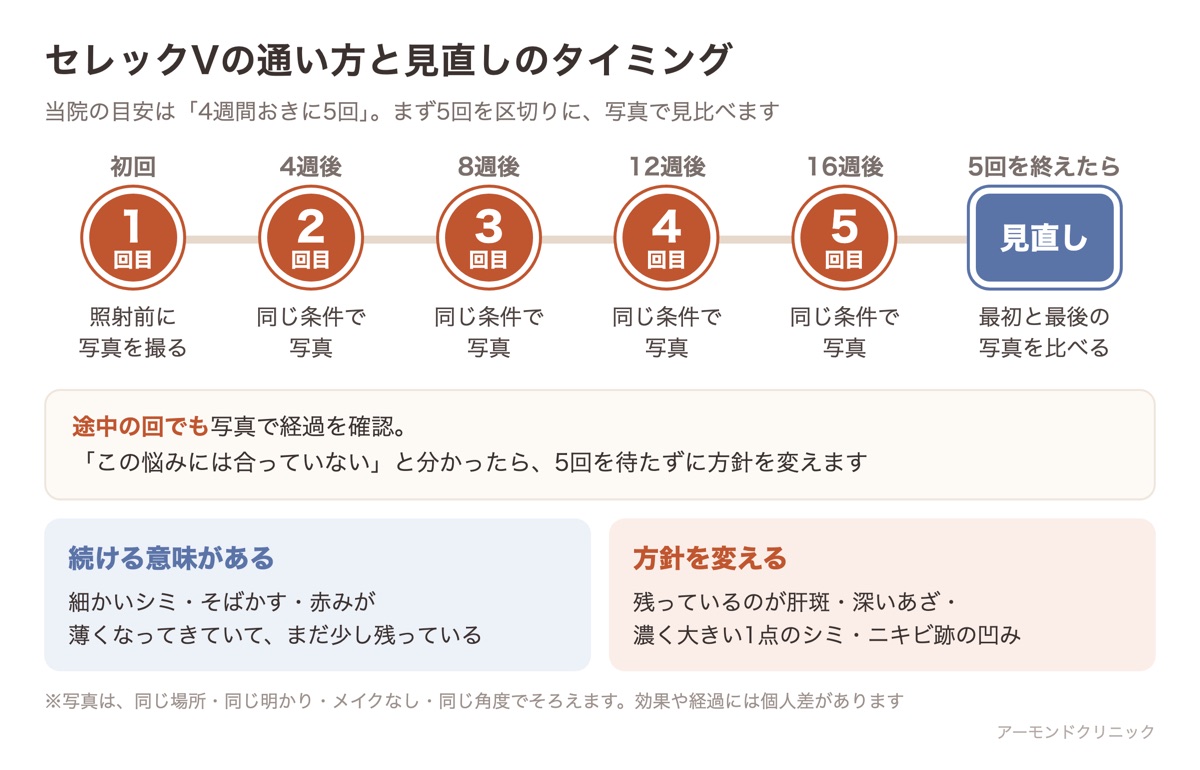 セレックVを4週間おきに5回通う流れと、写真で見比べて続けるか方針を変えるかを見直すタイミングの図