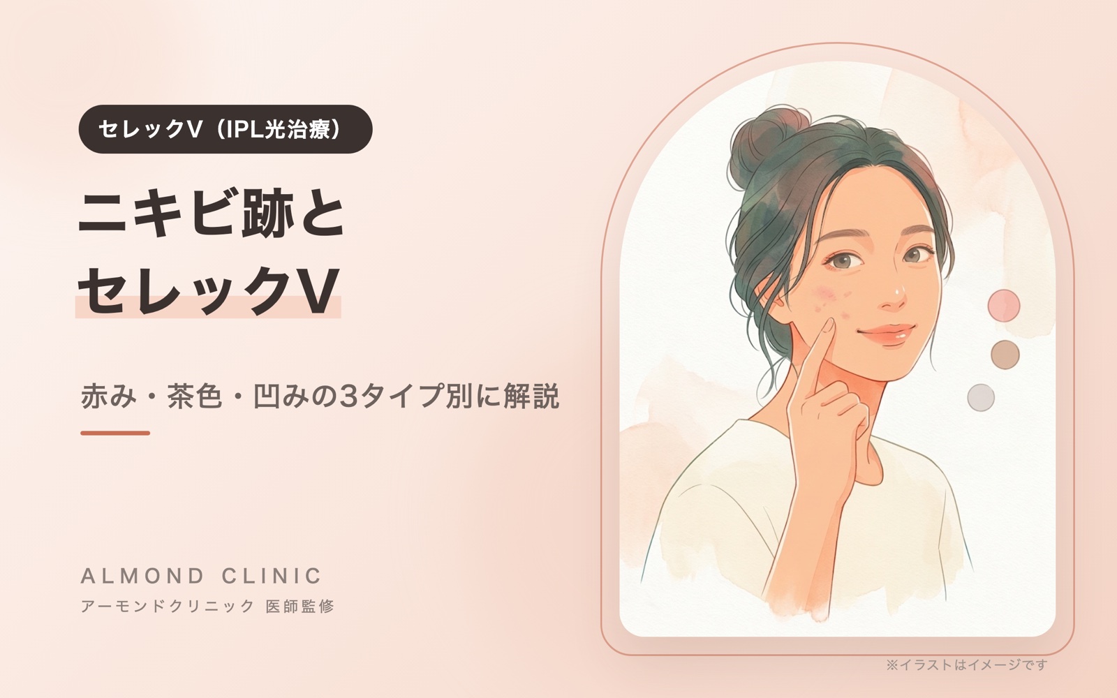 セレックV（IPL光治療）のコラムの表紙イラスト