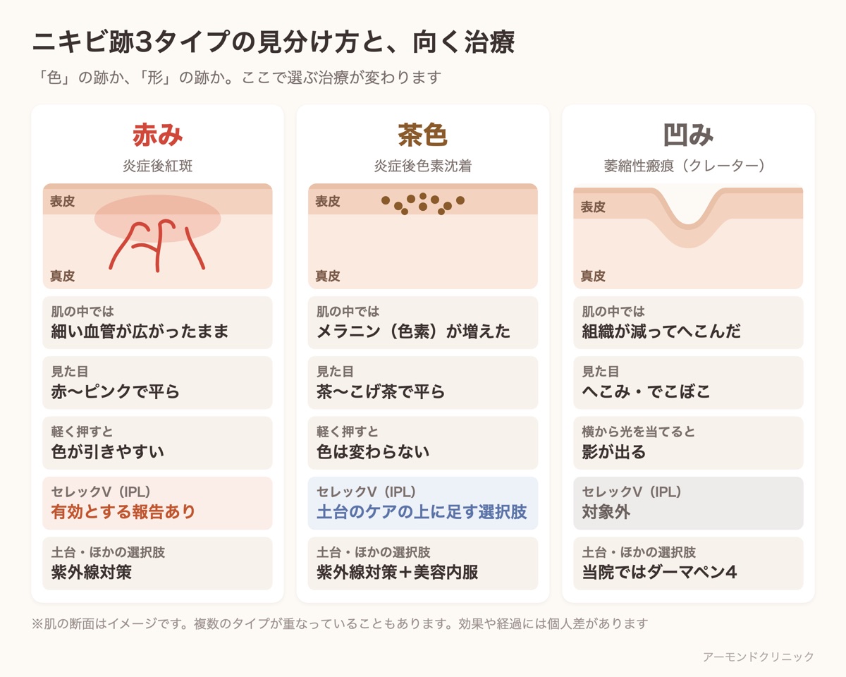 ニキビ跡の3タイプ（赤み・茶色・凹み）の肌の断面イメージと見分け方、セレックV（IPL）の向き不向きをまとめた表