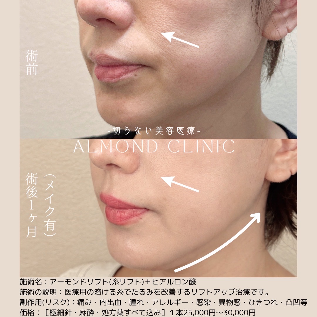糸リフト（アーモンドリフト）とヒアルロン酸の症例写真。術前と術後1か月（メイク有）の、ほうれい線とフェイスラインの比較