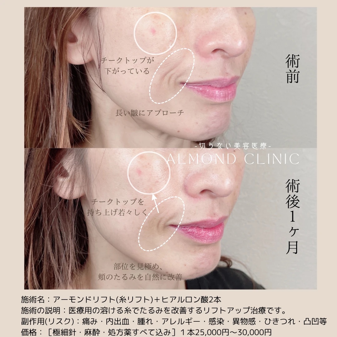糸リフト（アーモンドリフト）とヒアルロン酸2本の症例写真。術前と術後1か月の、頬のたるみとほうれい線の比較
