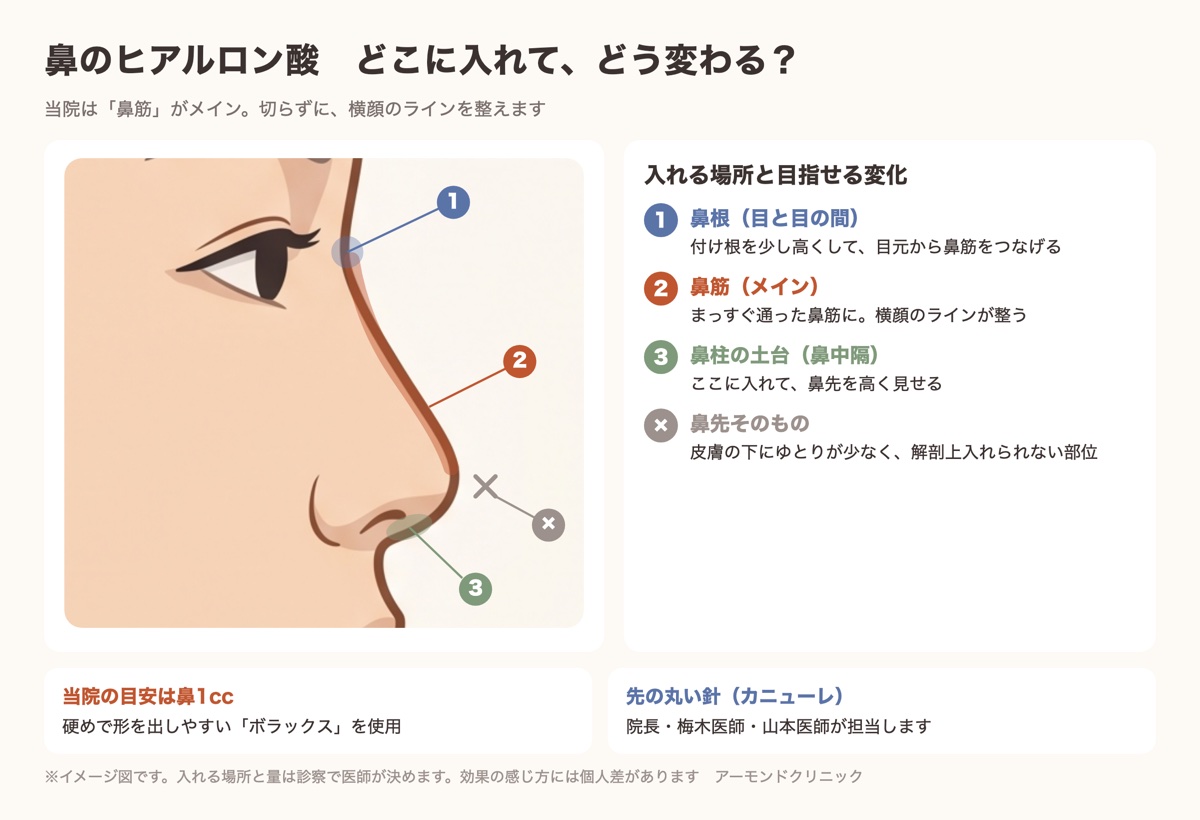 鼻のヒアルロン酸を入れる場所(鼻根・鼻筋・鼻柱の土台)を横顔で示した図