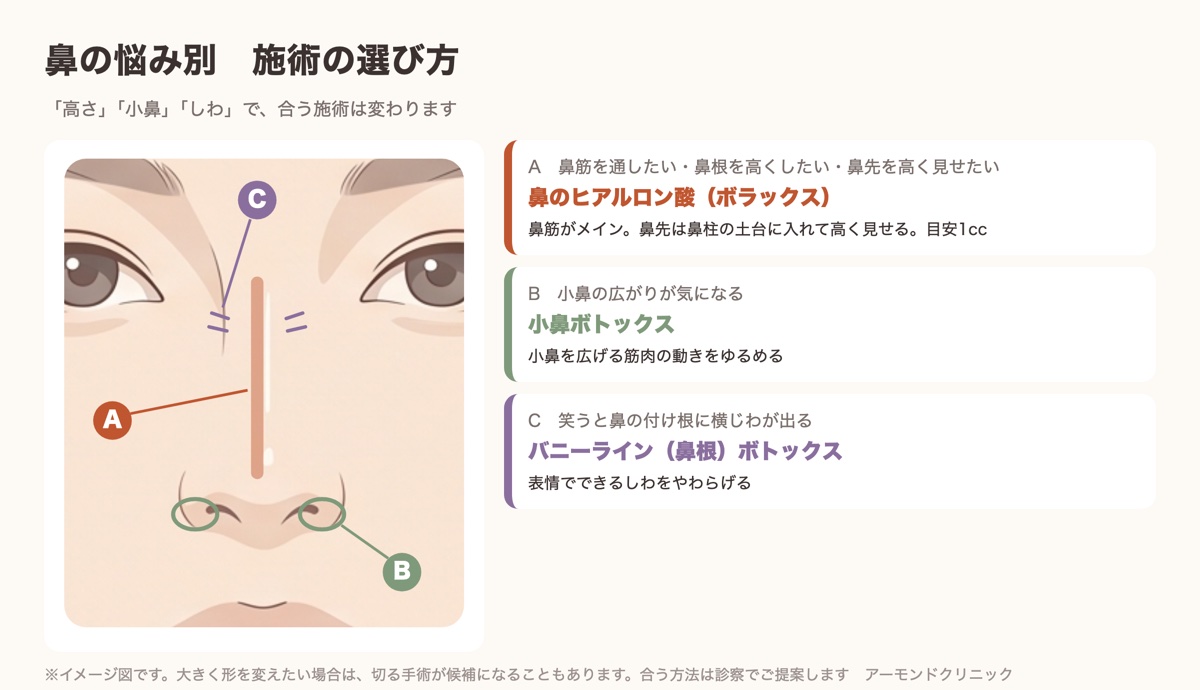 鼻の悩み別に鼻ヒアルロン酸・小鼻ボトックス・バニーラインボトックスの選び方を示した図